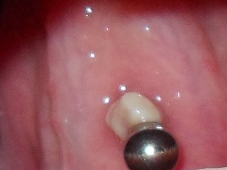 O piercing na boca inflamou: o que fazer?